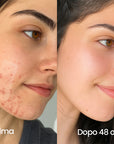 AreaFix™ Acne Diffusa – Seon
