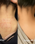 AreaFix™ Acne Diffusa – Seon