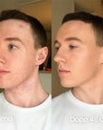 AreaFix™ Acne Diffusa – Seon