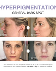 Klyne RX™ - Dark Spot Corrector