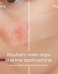 AreaFix™ Acne Diffusa – Seon