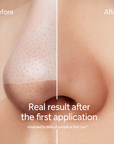 IonClear™ Blackheads Nose Patches - Seon
