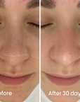IonClear™ Blackheads Nose Patches - Seon