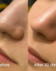 IonClear™ Blackheads Nose Patches - Seon