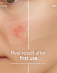 AreaFix™ AcneAway – Seon