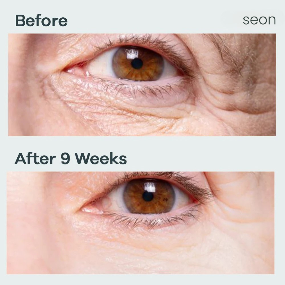 Eye NovaLift - Microinfusión patches