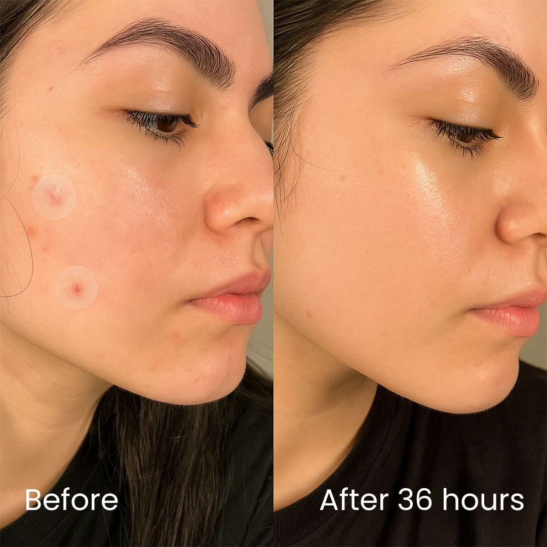 InvisiDots™ Pimples Patches – Seon