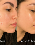 InvisiDots™ Pimples Patches – Seon