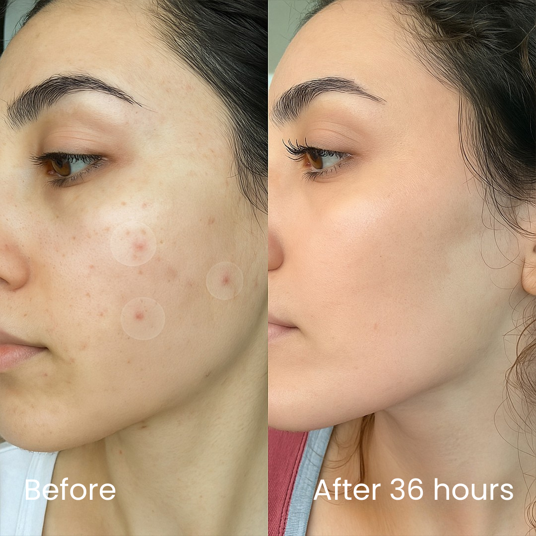InvisiDots™ Pimples Patches – Seon