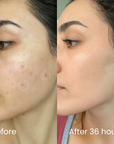 InvisiDots™ Pimples Patches – Seon